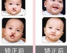 吃兔肉真的會(huì)長(zhǎng)兔唇？為什么會(huì)長(zhǎng)兔唇？